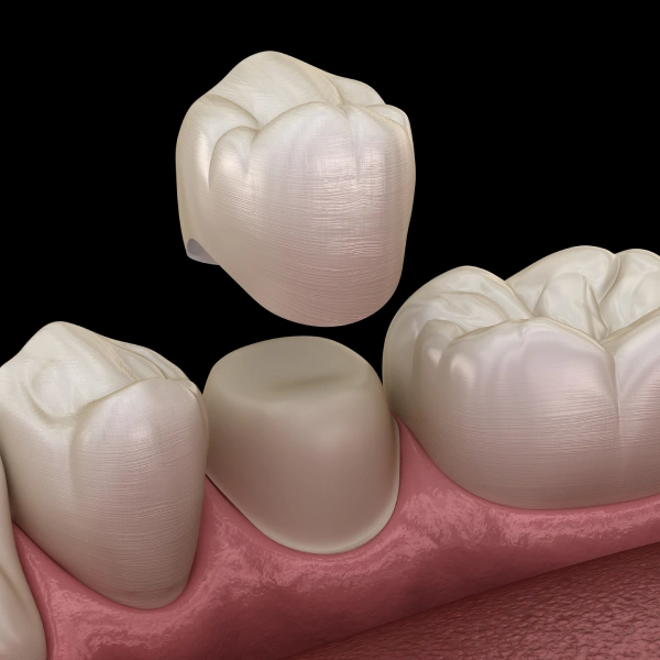 Dental Crowns