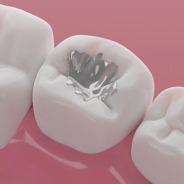 Dental Fillings