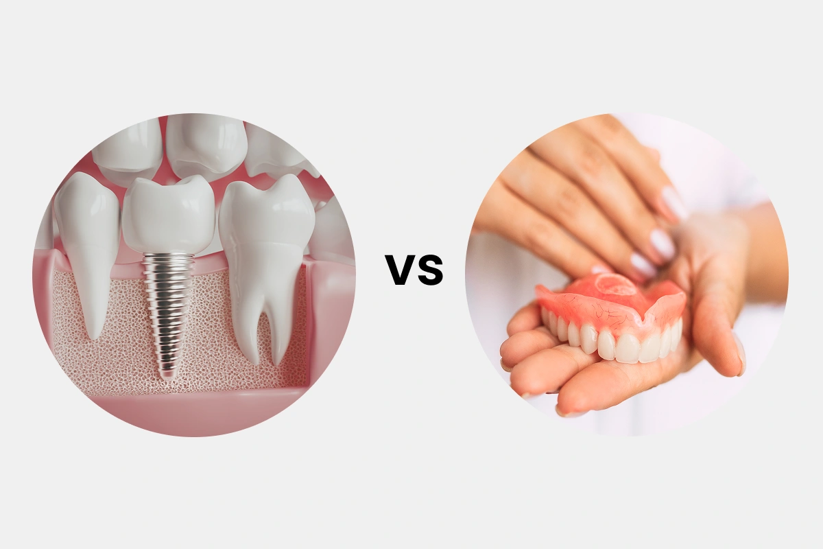 Dental Implants Vs. Dentures