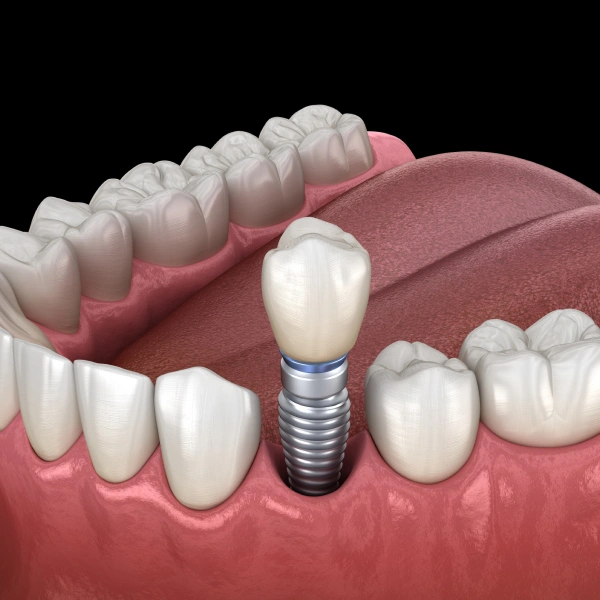 Dental Implants