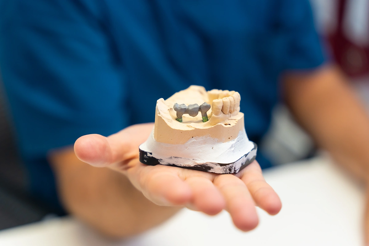 The Benefits of Implant-Supported Dentures