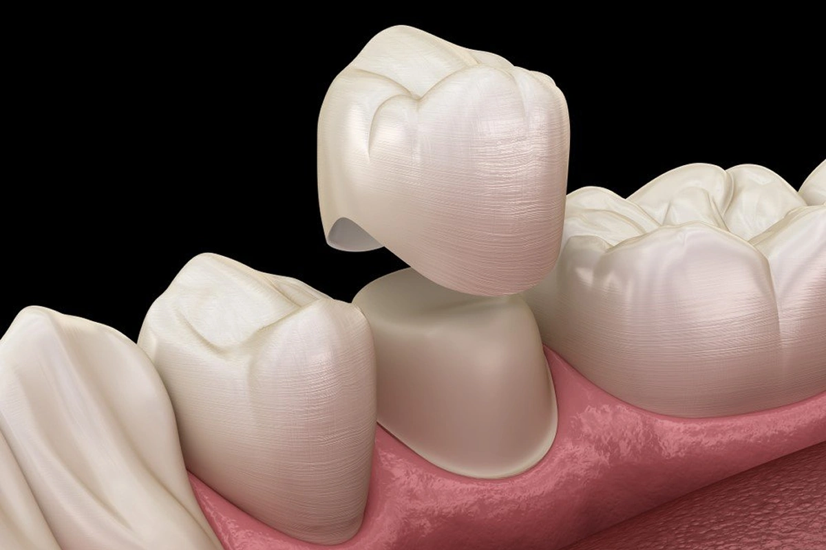 The Many Uses for Dental Crowns