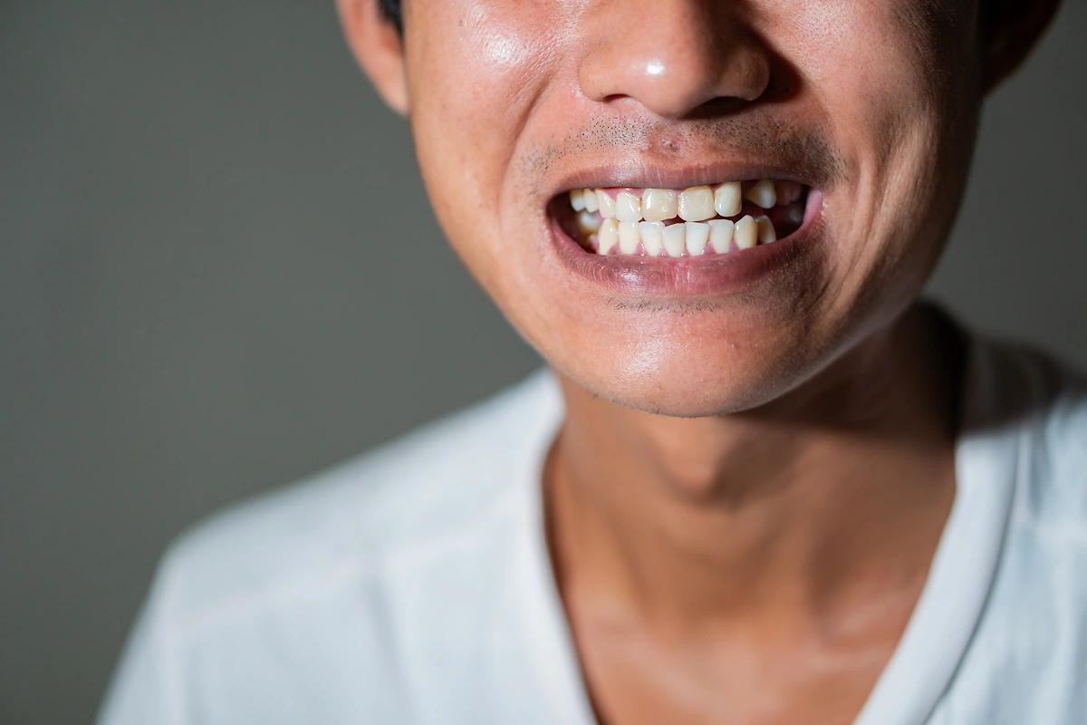 What Are My Options to Replace Missing Teeth?